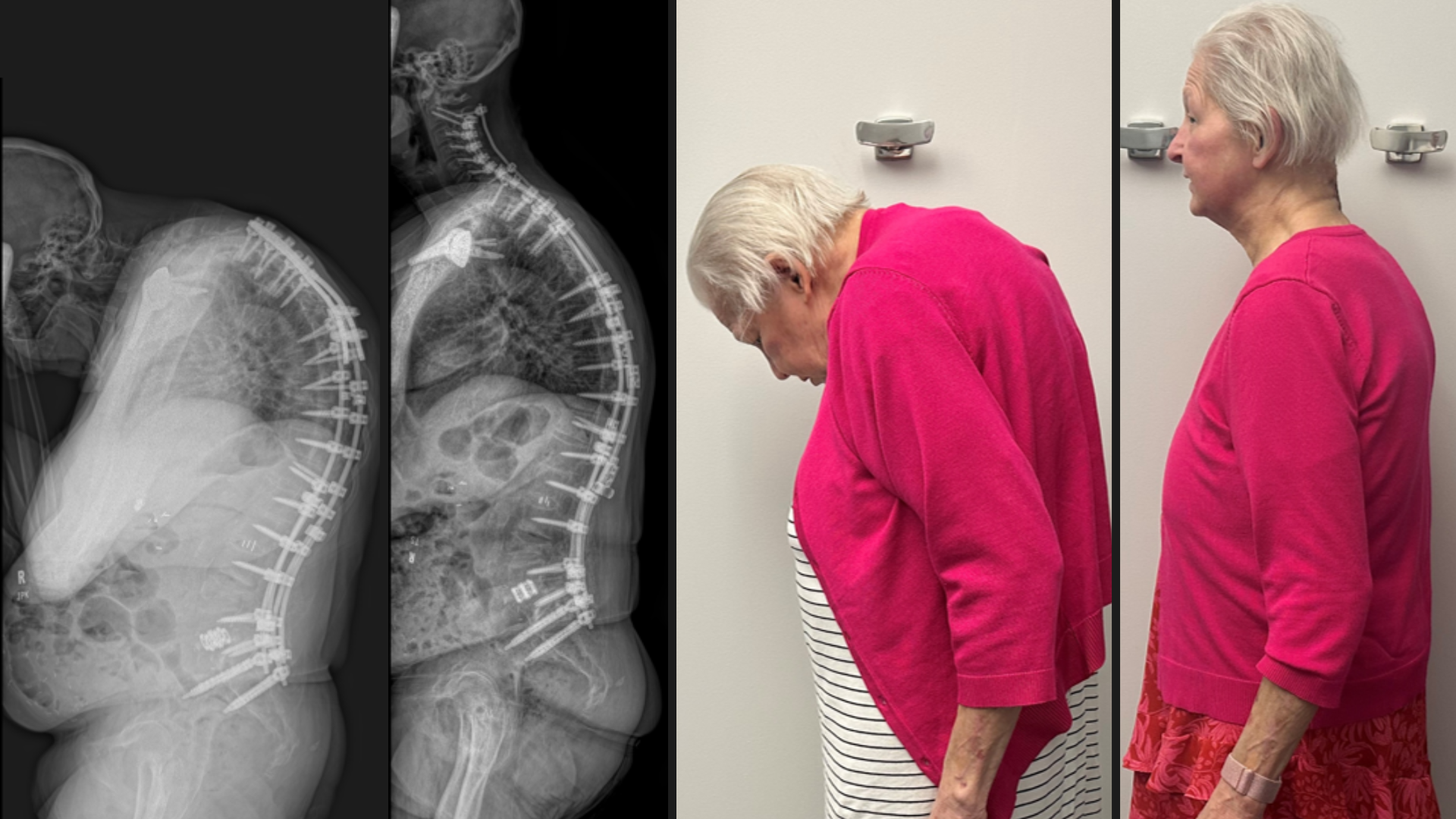 Read more about the article Surgery for Severe Spinal Deformity has Janet Looking Up